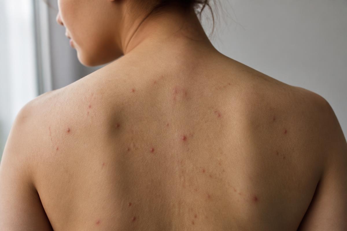 Close-up das costas de uma pessoa adulta com pequenas espinhas e lesões avermelhadas espalhadas pela pele, em luz natural